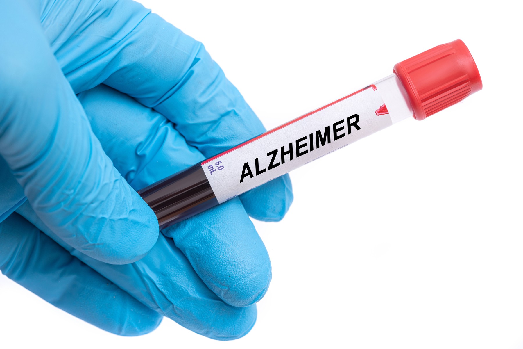 Test simplu de sânge: rezultate promițătoare pentru boala Alzheimer Test simplu de sânge: rezultate promițătoare pentru boala Alzheimer